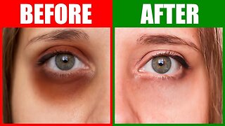 Fix the Root Cause of Dark Circles Under the Eyes