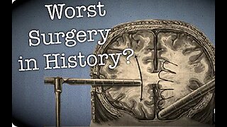 The Dark side of Science: The Lobotomy, the worst surgery in history?