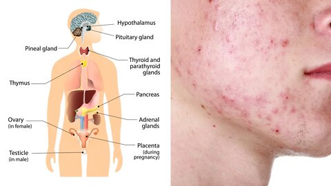 5 Foods That Destroy Your Hormones and Skin