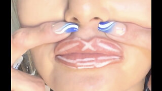 Lip Filler And Mapping