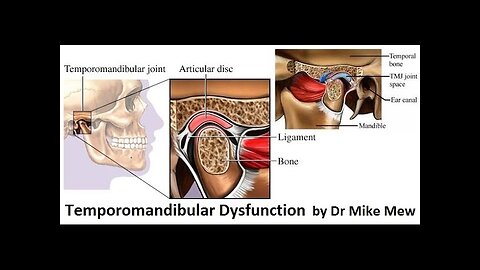 The Cause, Pathology, Diagnosis and Cure of Temporomandibular Joint Disorders by Dr Mike Mew