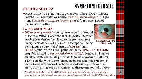 ALPORT SYNDROME in Pregnancy