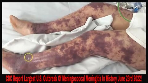 CDC - United States Largest Outbreak Of Meningococcal Disease June 23rd 2022!