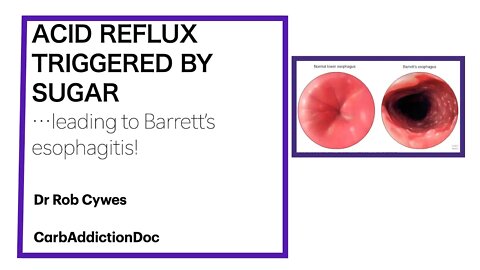 CarbAddictionDoc 3: ACID REFLUX TRIGGERED BY SUGAR...leading to Barrett's esophagitis