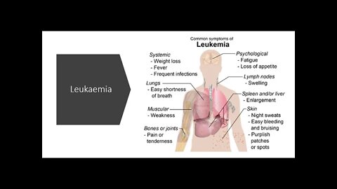 Leukaemia