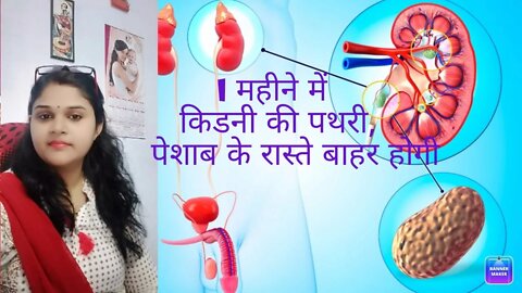 Renal stone/kidney stone (गुर्दे की पथरी) & it's treatment।।#renalstone #homeopathy #DrMinakshi