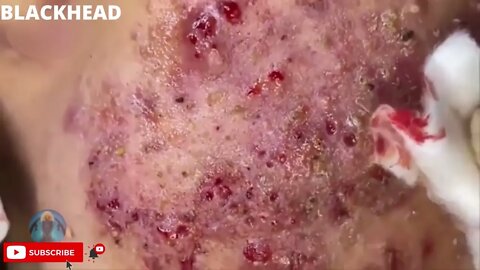 Extremely damaged face. Removal of #blackheads and #pimples in critical condition.