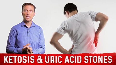 Relation Between Ketosis & Uric Acid Stones – Dr.Berg on Keto Kidney Stones