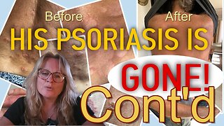 How My Husband Cured Psoriasis using MMS Chlorine Dioxide