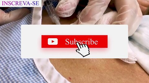 Satisfactory Video Blackhead Removal Skin Cleansing #10 | 2022 Video