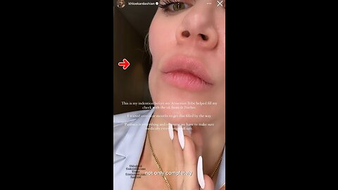 Khloe Kardashian opens up on her skin cancer journey!
