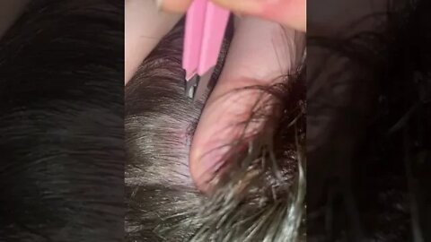 Huge Ingrown Hair