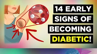 14 Early Signs of Diabetes (Prediabetes)