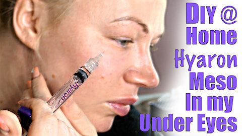 Improve your Under eyes with Hyaron Meso Therapy from acecosm.com | Code Jessica10 Saves you Money!