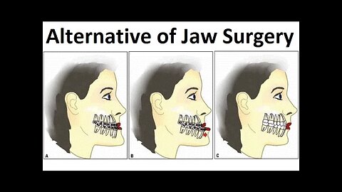 Are There Any Alternatives of Oral/ Jaw/ Prognathic Surgery by Prof John Mew