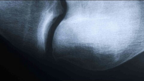 BONE ON BONE KNEES AND INFLAMED PROSTATE DR JOEL WALLACH