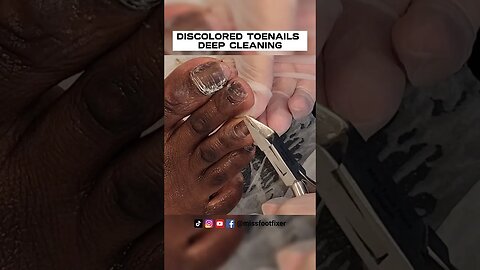 CLEANING TOENAIL 🦶🏽: DISCOLORED TOENAILS DEEP CLEANING BY FAMOUS PODIATRIST MISS FOOT FIXER