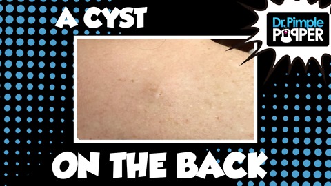 A Cyst on the Back