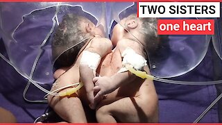 Conjoined twin girls share a single heart