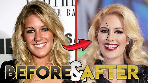 Heidi Pratt | Before and After Transformations | Heidi Montag from The Hills