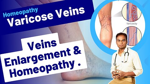 Varicose Veins and Homeopathy Treatment . | Dr. Bharadwaz | Medicine, Surgery & Homeopathy