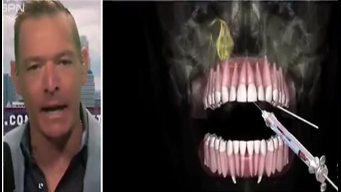 SHOCK CLAIM: Dental Anesthetic POISONED With Nano Tech: Graphene Oxide & Hydro Gel Used In Dentistry