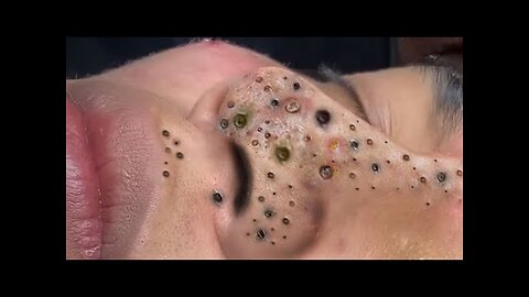 Unbelievable Pimple Popping! Watch Ultimate Satisfaction #PimplePopper #MustSee #Viral