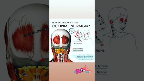 OCCIPITAL NEURALGIA