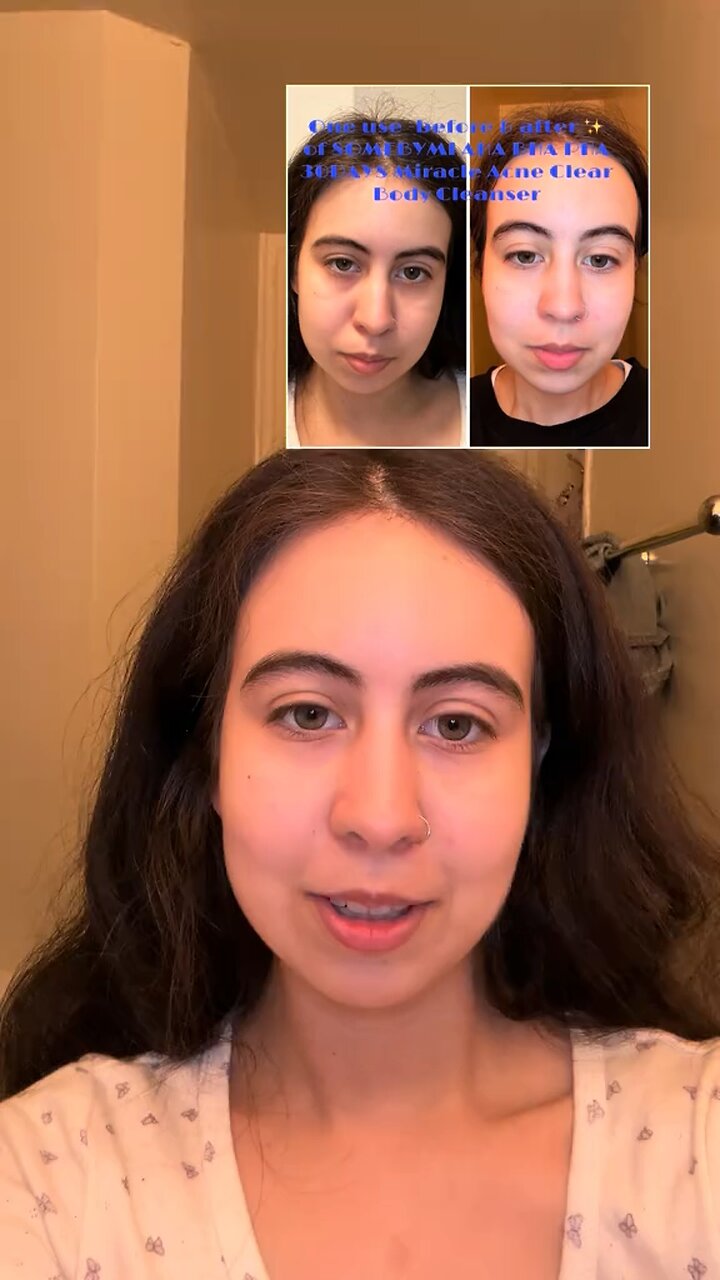 First impressions- AHA BHA PHA 30 Days Miracle Acne Clear Body Cleanser ...