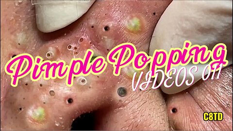 Satisfying Pimple Popping Videos 011