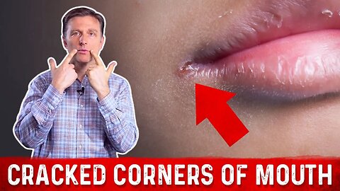 What Causes Cracked Corners of Mouth & How to Get Rid of Angular Cheilitis? – Dr. Berg