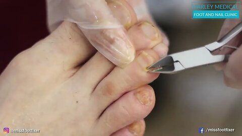 HOW TO GET RID OF FUNGAL INFECTION ON NAILS BY MISS FOOT FIXER MARION YAU