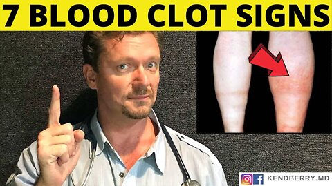 7 Warning Signs of a BLOOD CLOT (Symptoms) 2021