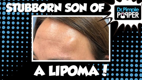 Stubborn Son of A Lipoma on The Forehead