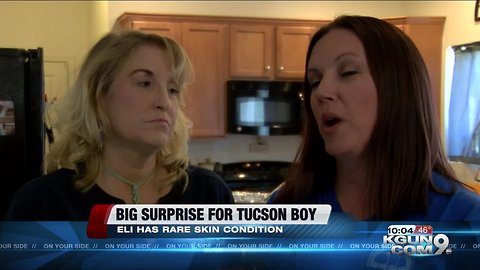 Tucson boy with rare, painful skin condition gets surprise donation