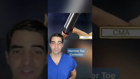 Hammer toe correction