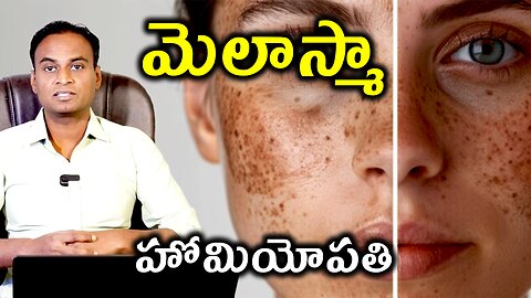 మెలాస్మా హైపర్పిగ్మెంటేషన్ | మంగు మచ్చలు | Melasma Treatment & Cure | Melasma Remedy | Homeopathy