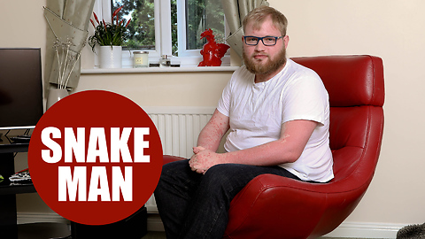 Hospital worker tells how painful psoriasis has turned him into a "human snake"