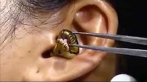 ‘Surgeon’ struggles to remove live snake from woman’s ear in viral video