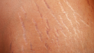 The Easy Way to Get Rid of Stretch Marks