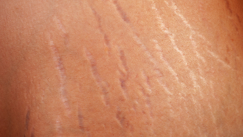 The Easy Way to Get Rid of Stretch Marks