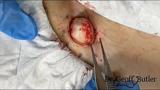 Cyst removal from the groin