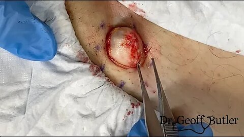 Cyst removal from the groin