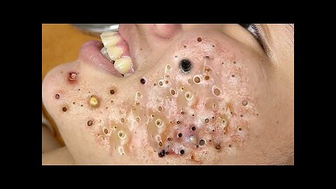 Satisfying Blackheads Cystic Acne Whiteheads Extraction | Dr. Pimple Popper 101