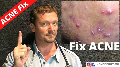 BAD ACNE? (Avoid these Foods!!!) 2021