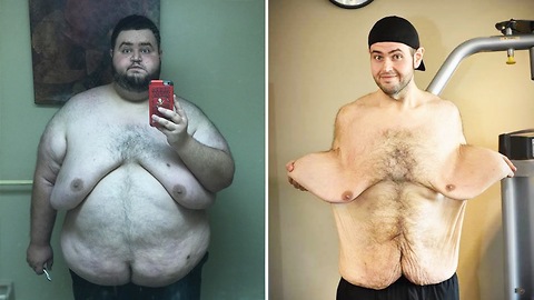 Guy Lost 300 Lbs And Now He Has 13 Lbs Of Loose Skin