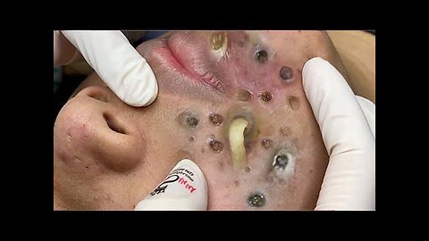 pimple cyst satisfatory Blackhead extration removal #blackhead