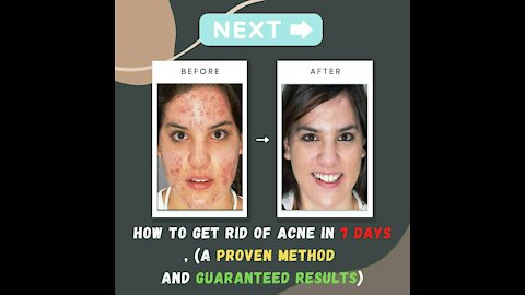 How to get rid of acne in 7 days, (a proven method and guaranteed results)