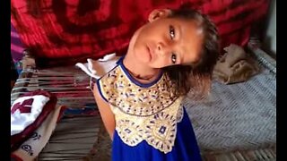Pakistani child's head permanently bent at 180 degrees