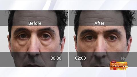 Rapidly Fix Puffy Eyes in Minutes